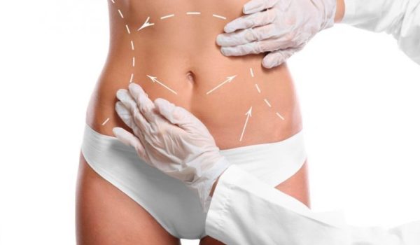 Liposuction-e1523397386589